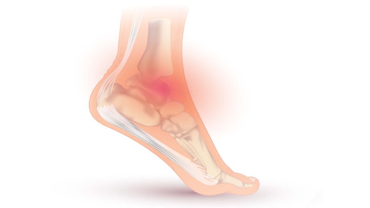 Ankle Injury
