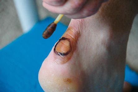 Blister-Taping-(2-of-14).jpg 28217 treat blisters