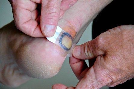 Blister-Taping-(3-of-14).jpg 28218 treat blisters