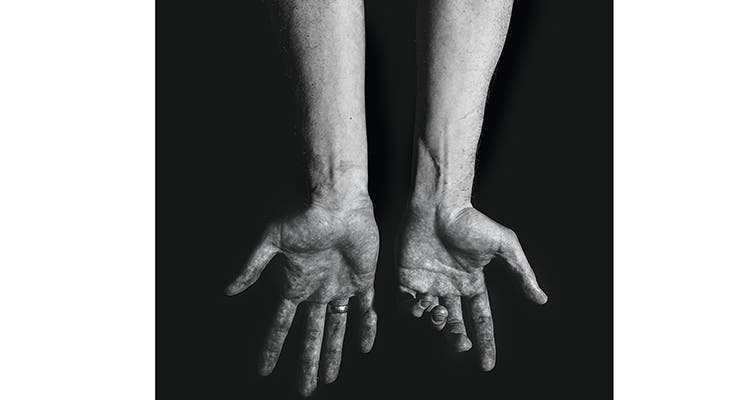 Image of Mike Gersack's hands after a bear attack by Ben Fullerton