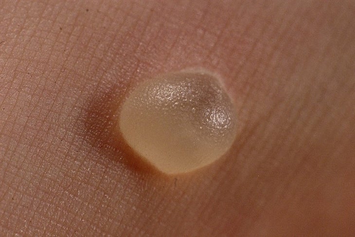 "blister"