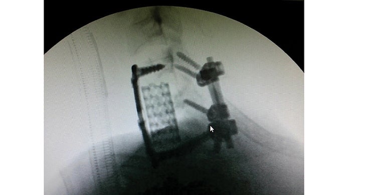 BP1115SURV_C_Zick_fusion-surgery-immediately-after-procedure.-Hardware-Cage-holding-C4-C7-vertebrae-in-place_750x400 Spinal cord