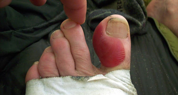 3. Your feet are mostly moleskin, duct tape, and callouses. Proper hiking boot fit is essential, but even the best boots can’t prevent every blister, especially with the high mileage a thru-hike demands.…