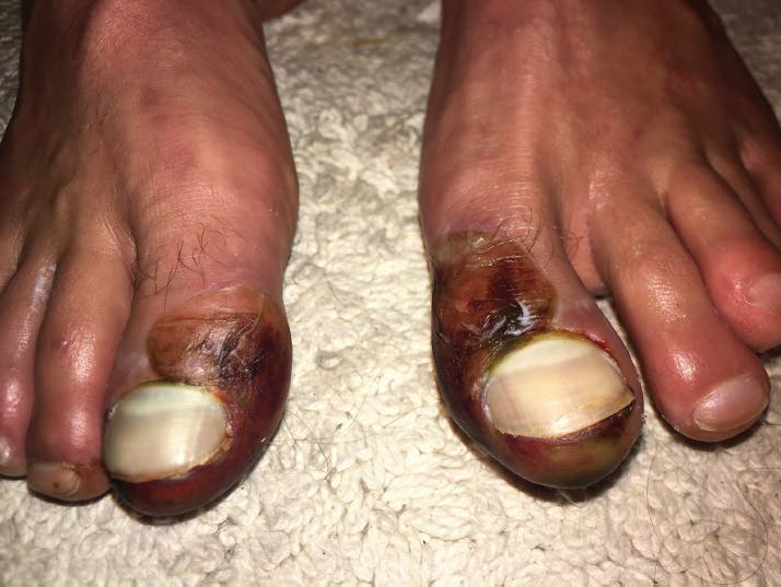 Matthew’s toes, two weeks after the rescue.