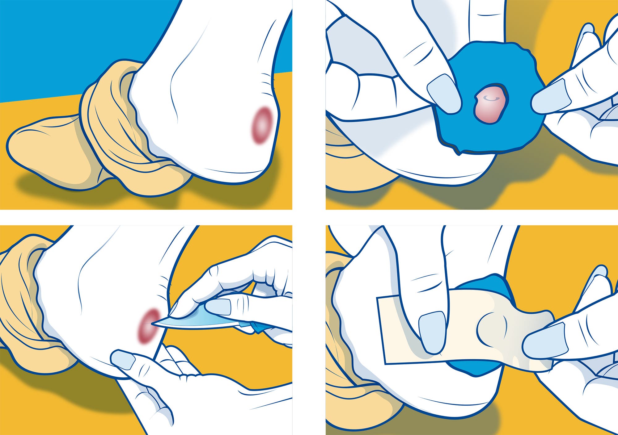 Wilderness maladies blisters